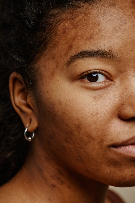 Uneven Skin Tone