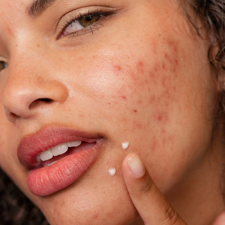 Acne Prone